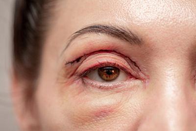 Blepharoplasty-in-Menasha-WI