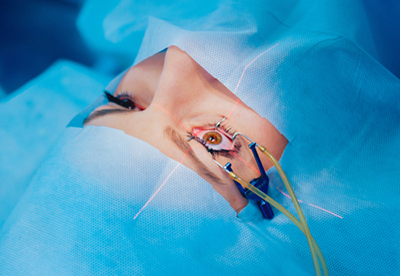 Lasik Surgery