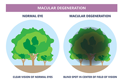 Macular Degeneration Management